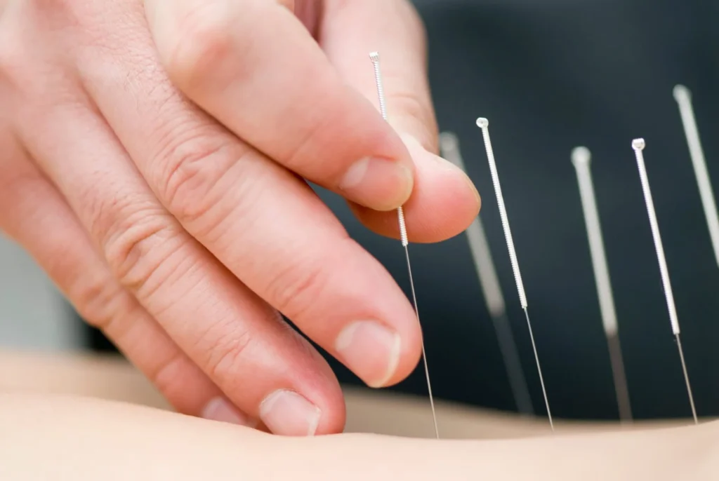 Dry Needling For Muscular Pain in Cranston, RI | Viva Health