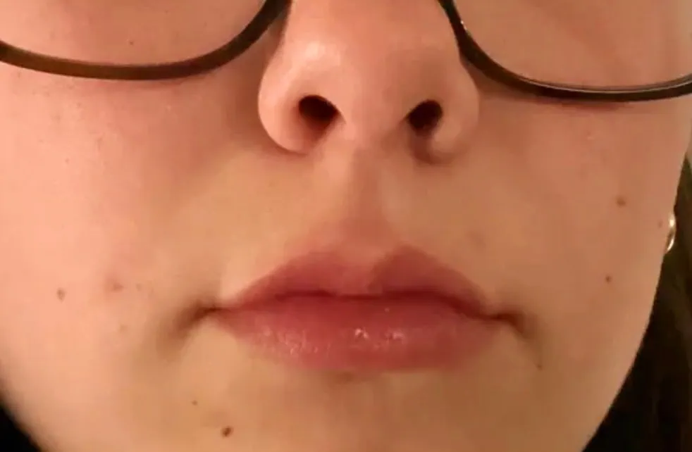 Lip Flip Treatment in Cranston, RI | Enhance Your Smile