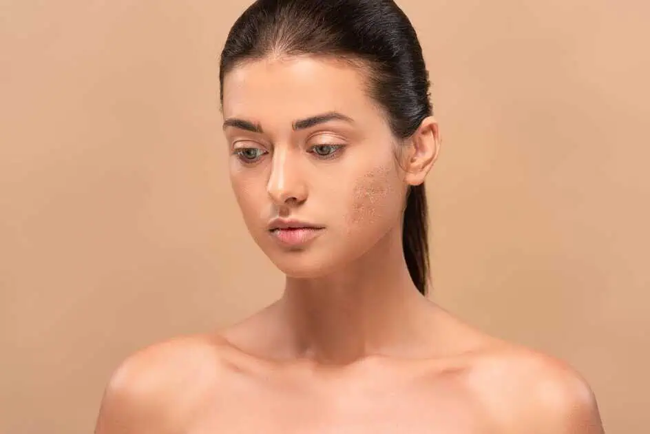 Acne Scar Removal in Cranston, RI | Smooth & Clear Skin