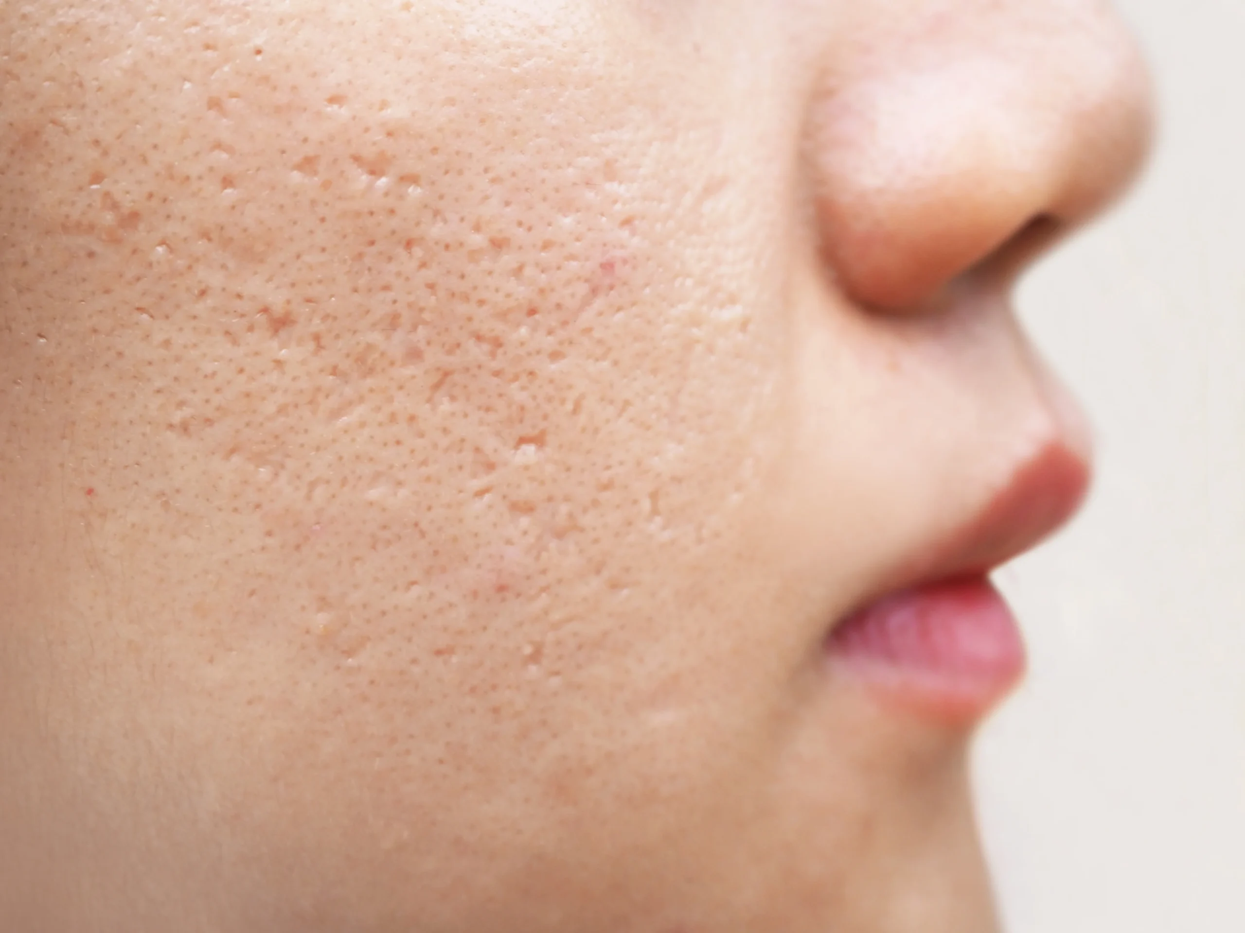 What Are the Best Treatments for Reducing Acne Scars