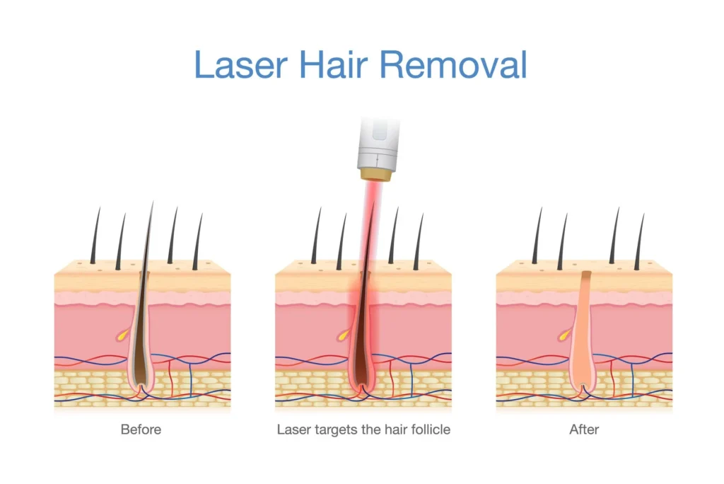 Laser Hair Removal in Cranston, RI