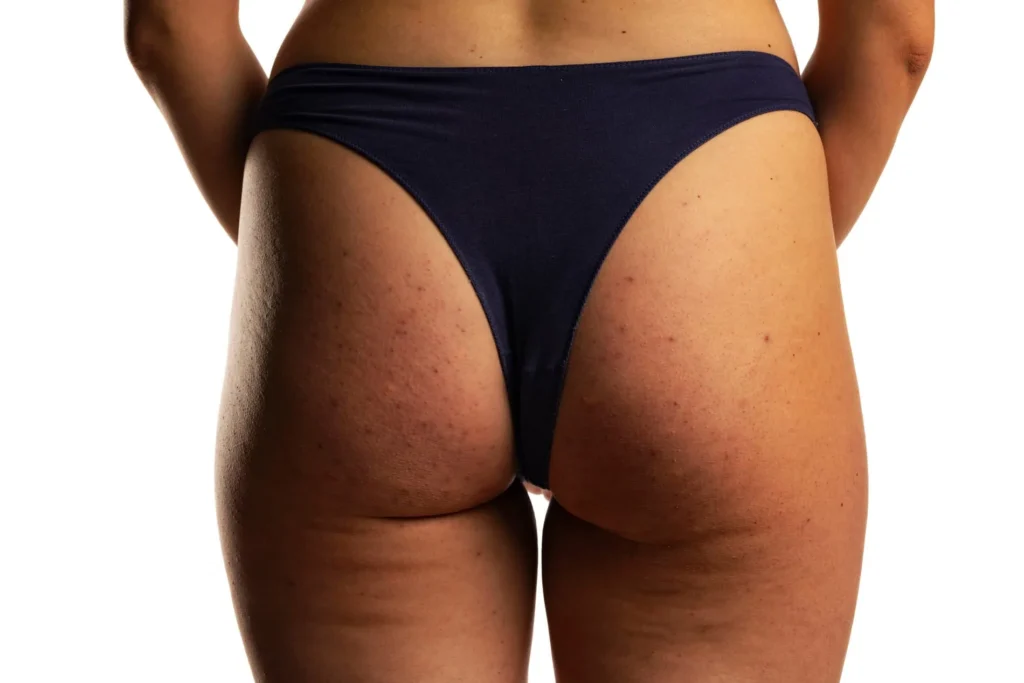 Enhance Flat Buttocks in Cranston, RI | Viva Medspa