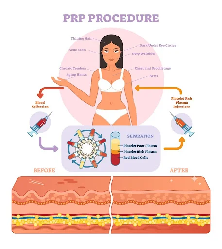 PRF and PRF EZGel in Cranston, RI - VIVA MED SPA