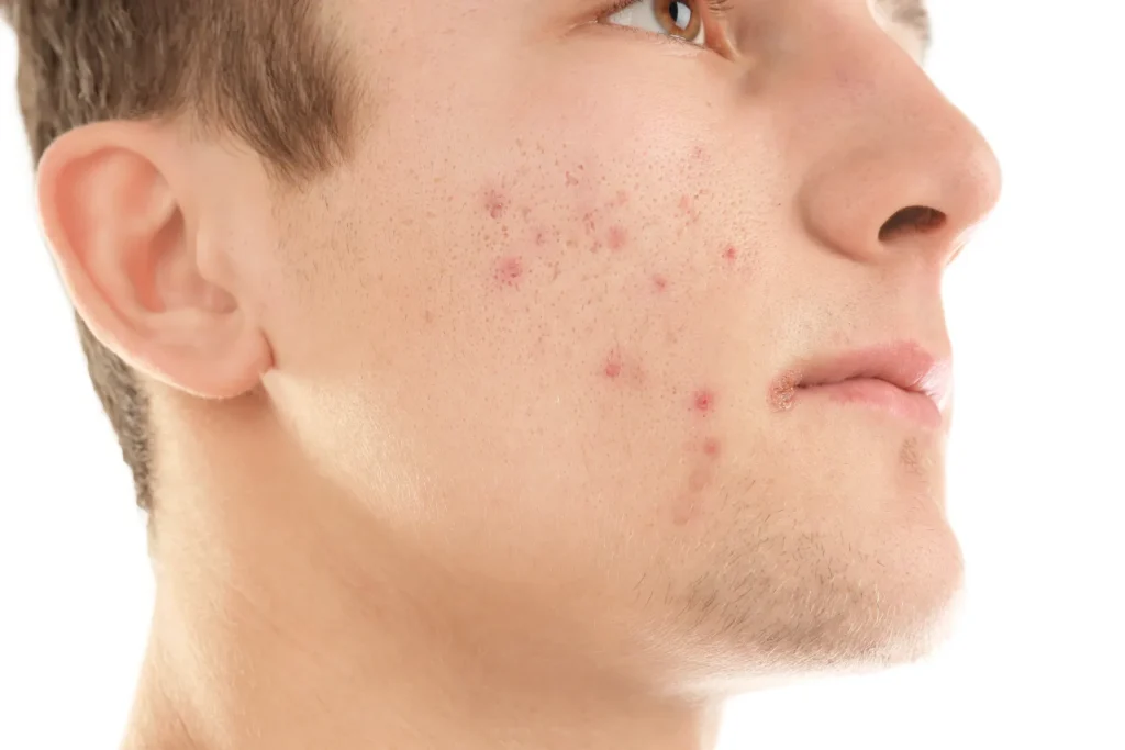 Close-up of young man with active acne on face – men's active acne treatment in Cranston, RI