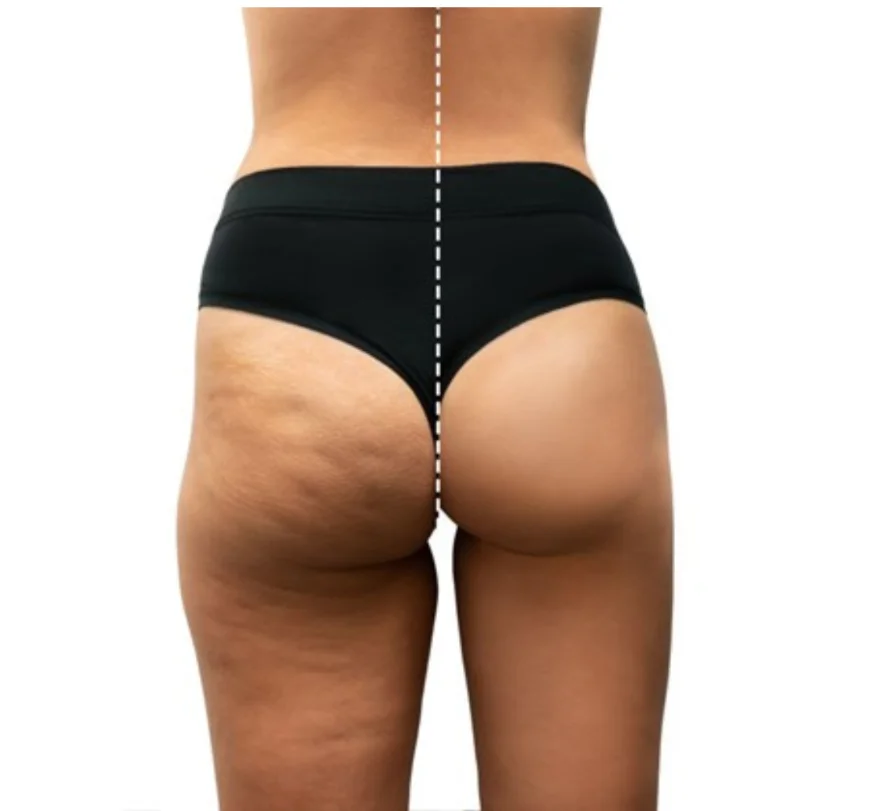 Skin Tightening with T-Shape 2 in Cranston, RI