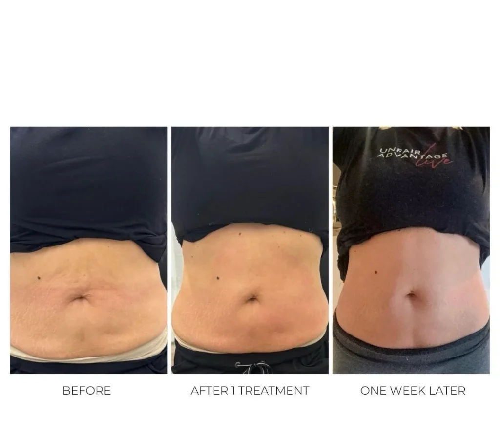 Patient undergoing treatment for abdominal skin laxity in Cranston, RI