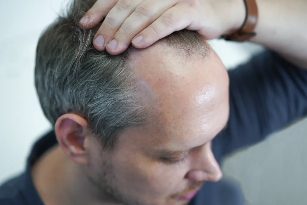 Patient consulting for thinning hair solutions in Cranston, RI