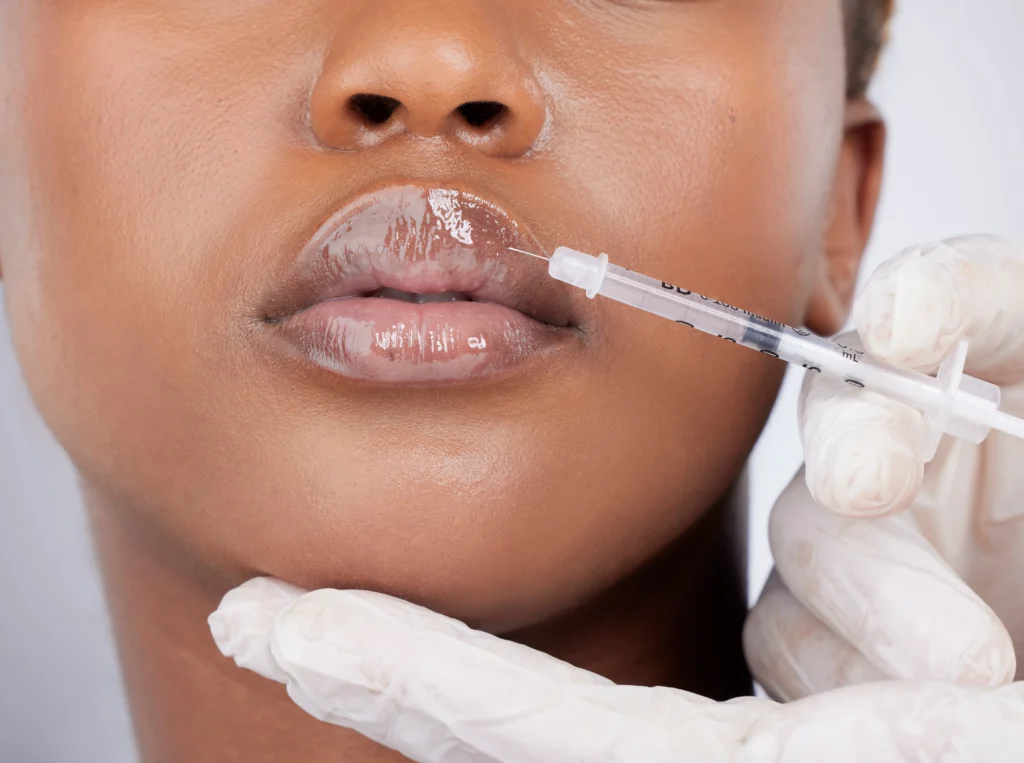 Lip Fillers at Viva Medspa & Wellness in Cranston, RI