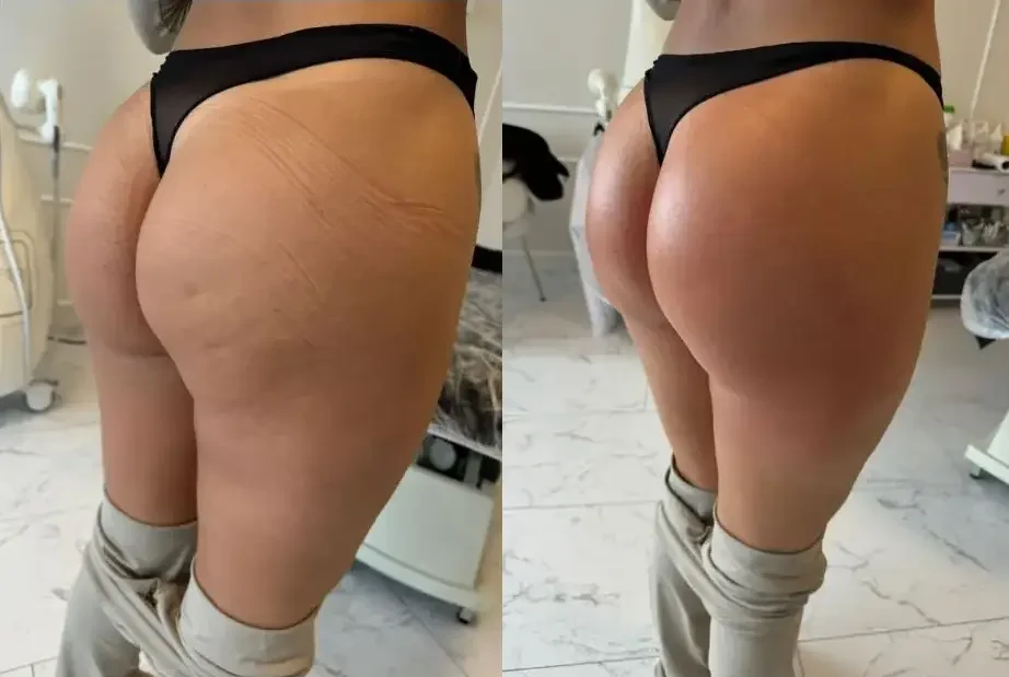 T-Shape 2 in Cranston, RI - Viva Medspa & Wellness