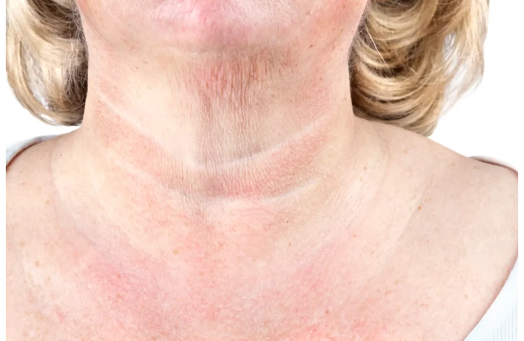 Crepey Skin in Cranston, RI