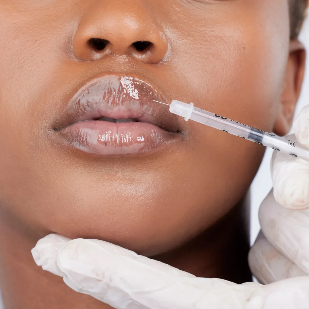 Lip Fillers at Viva Medspa & Wellness in Cranston, RI