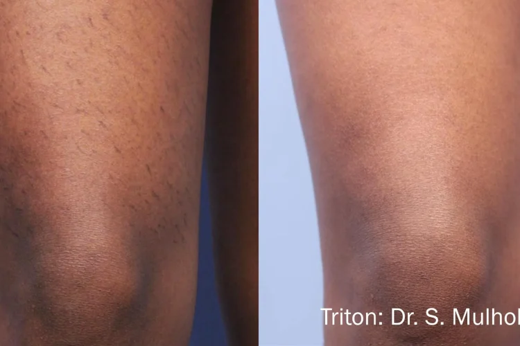 triton-before-after-dr-s-mullholland-preview-3